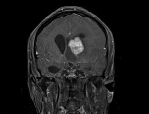 Radiology Of Sega Sagittal A Axial B And Coronal C T Weighted