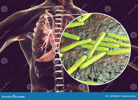 Secondary Tuberculosis In Lungs And Close Up View Of Mycobacterium