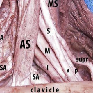 Plexo Braquial A Nivel Supraclavicular Supr Nervio Supraclavicular