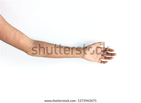 Swollen Red Rash After Bee Sting Stock Photo 1273963675 | Shutterstock