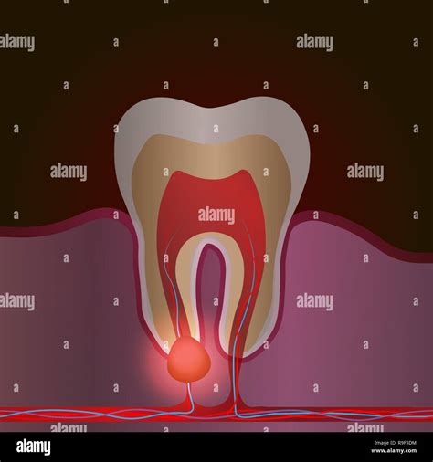 Dental Disease With Pain And Inflammation Medical Illustration Of