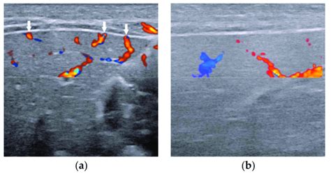 The Presence Of Hepatic Subcapsular Flow Arrows In Biliary Atresia