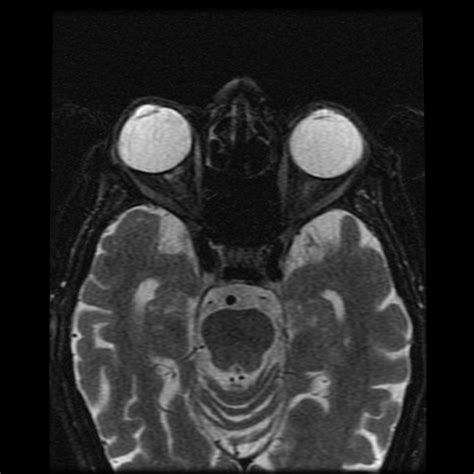 Progressive Supranuclear Palsy Image