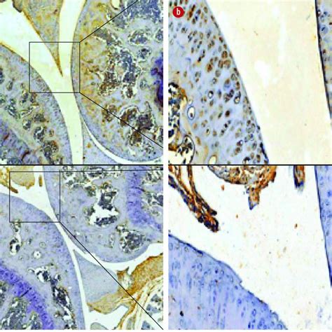 Immunohistochemical staining of hypoxia inducible factor 1α HIF 1α in