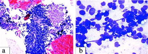 A Small Cell Carcinoma Loosely Cohesive Clusters Of Small Cells With Download High