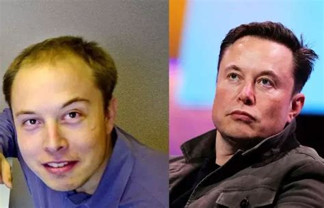 Elon Musk Hair Transplant - Mayclinik