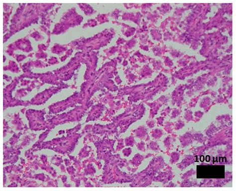 Genetic Alterations In Lung Adenocarcinoma With A Micropapillary Component