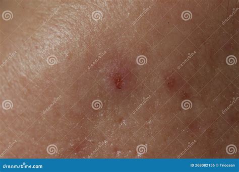 Texture Of Problematic Human Skin With Large Looking Open Pores And