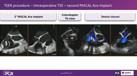 Tailoring Tricuspid Regurgitation Patient Treatment With The Pascal