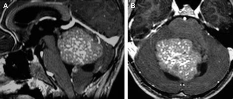 Posterior Fossa Tumors Neuroimaging Clinics