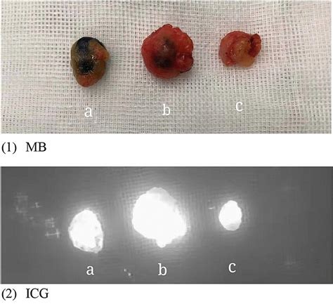 Lymph Node Labeled By Mb And Or Icg Three Sentinel Lymph Nodes Were