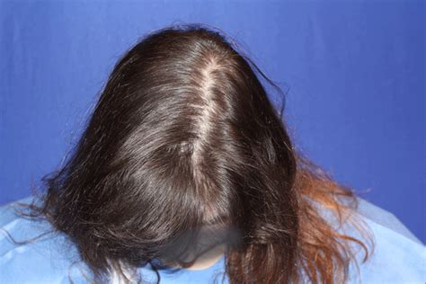 Hair Loss In Women | TrichoStem Hair Regeneration Centers