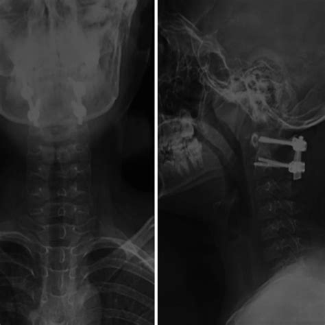 Postoperative Radiographs Anteroposterior Left And Lateral Right Download Scientific