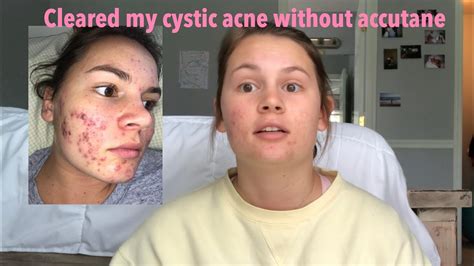 How I Cleared My Cystic Acne Without Accutane Youtube