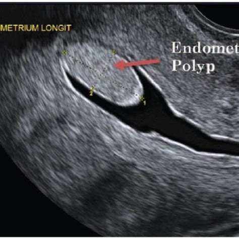 Pdf Endometrial Polyps Pathogenesis Sequelae And Treatment