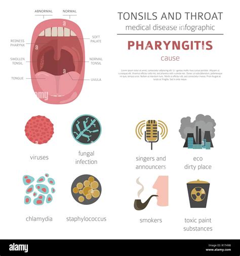 Chlamydia Throat Treatment