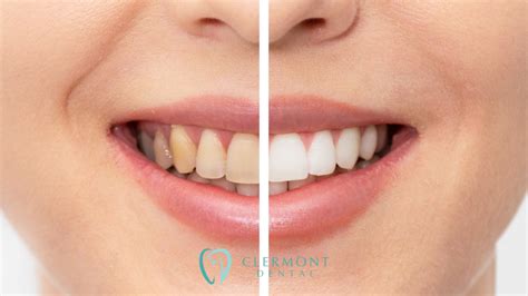 Natural Tooth Color Causes Of Discoloration Clermont Dental