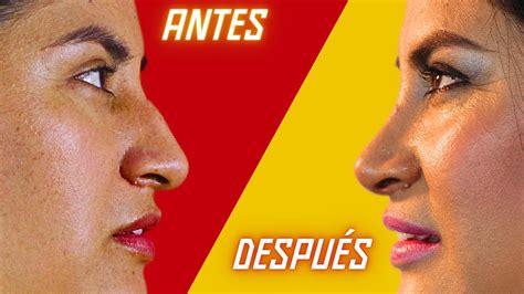 Una RinoplastÍa Lo Cambia Todo Rinoseptoplasta 👃🏼nariz Grande Y