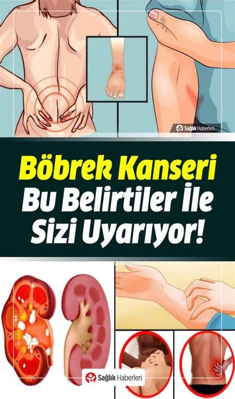 Böbrek Kanserinin Bu Belirtilerine Dikkat Kanser Karın kası rutin