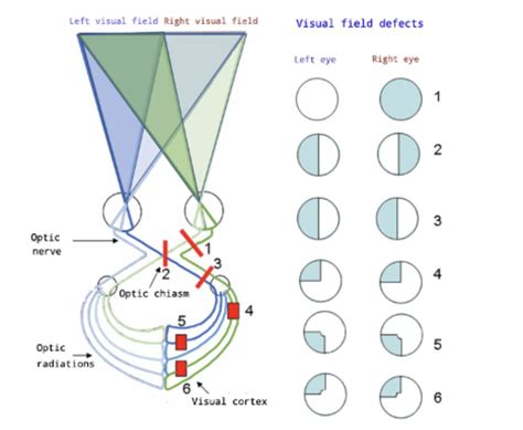 Visual Field Defects: A Summary - Mind The Bleep