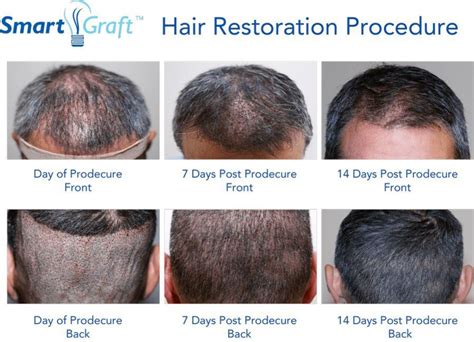 Smartgraft™ San Antonio Tx Hair Transplant Dr Constance Barone