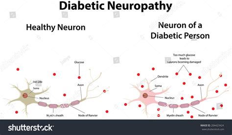 30 Polyneuropathy Stock Vectors, Images & Vector Art | Shutterstock