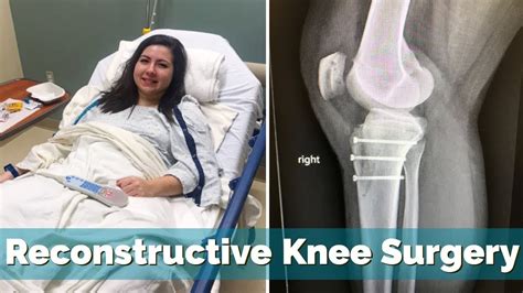 Reconstructive Knee Surgery Tto Mpfl Oca And Lateral Lengthening December 31 2018 Vlog 24