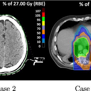 Axial Slices Of All The Cases With Overlaid Dose Distributions