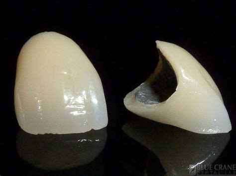 All Ceramic Crown Vs Porcelain Fused Metal