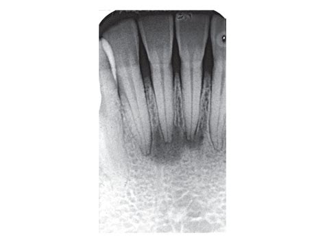 Apikale Parodontitis Definitionen Odontium Zahnschmelz Dentin