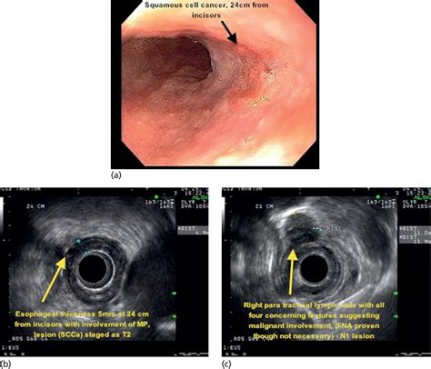 Esophageal Tnm Staging