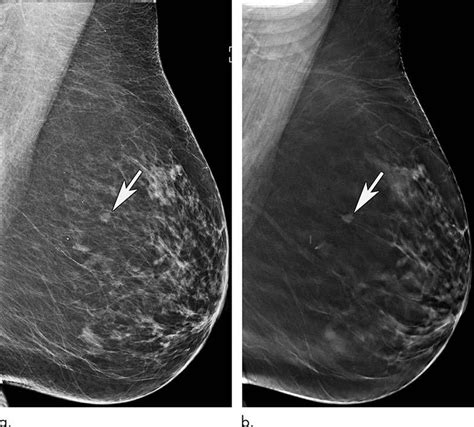 Older Women 3d Mammography Rsna