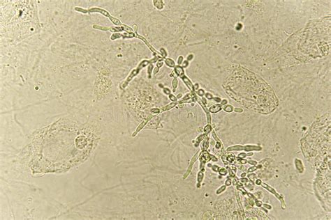 Pseudohyphae And Budding Yeast Cells In Patient Urine Stock Image