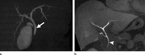 Biliary Anatomy A Ct Cholangiogram Shows The Common Bile Duct