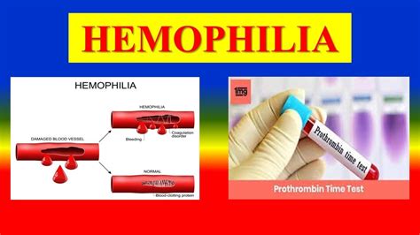 Hemophilia Definition Types Pathophysiology Clinical