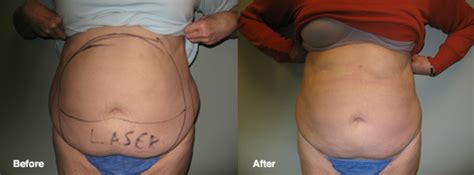 Lipo Photo Gallery Smart Lipo Cleveland