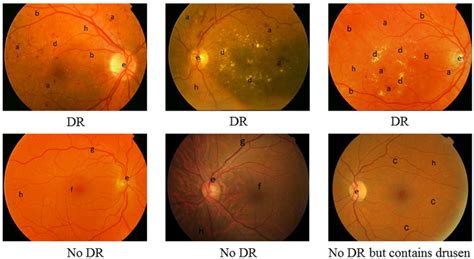 Fundus images. a. Haemorrhage; b. MA; c. Drusen; d. Exudates; e. Optic... | Download Scientific ...