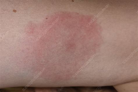 Spider Bite Allergic Reaction Rash