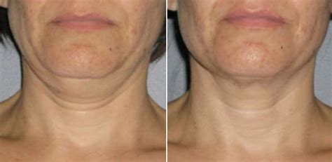 How Does Ultherapy Tighten Skin Boston Ultherapy Krauss Dermatology