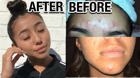 How I Went From Cystic Acne To Clear Skin Tips To Clear Your Skin