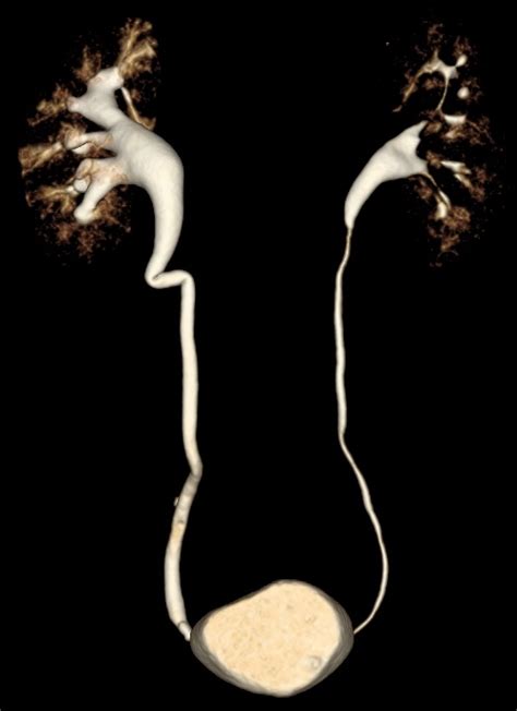 Retroaortic Left Renal Vein Type I Image