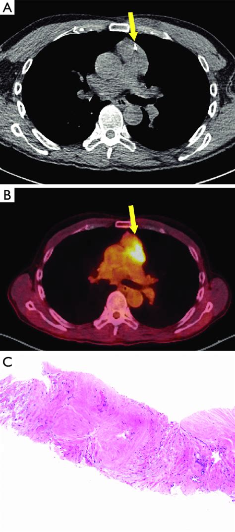 Case 2 biopsy. During CT-guided biopsy, the needle (A, arrow) entered a ...