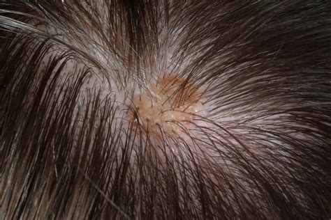 scalp conditions pictures - pictures, photos