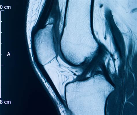 Partial Knee Ligament Tears Acl Mcl Pcl Causes And Treatments