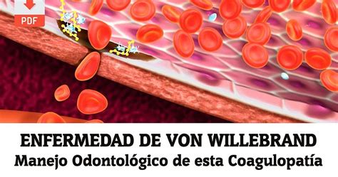 Pdf Enfermedad De Von Willebrand Manejo Odontológico De Esta Coagulopatía Ovi Dental