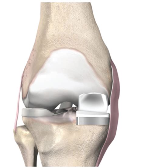 Protesi Monocompartimentale Di Ginocchio Di Cosa Si Tratta E Quando