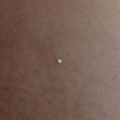 This White Pearl Just Popped Out Of A Keloid Scar I Have Hard Af Rpopping