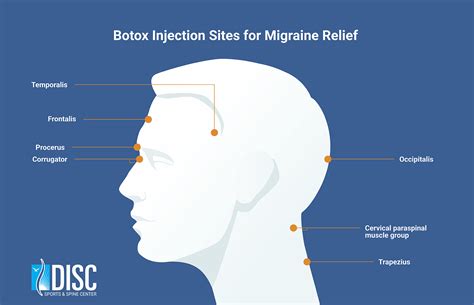 Botox Injections For Migraines