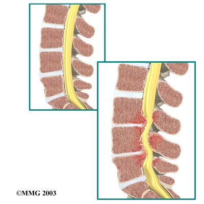 Lumbar Spinal Stenosis | eOrthopod.com