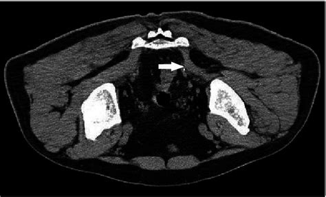 Computed Tomography Showing Atrophy Of Right Piriformis Muscle After Ct